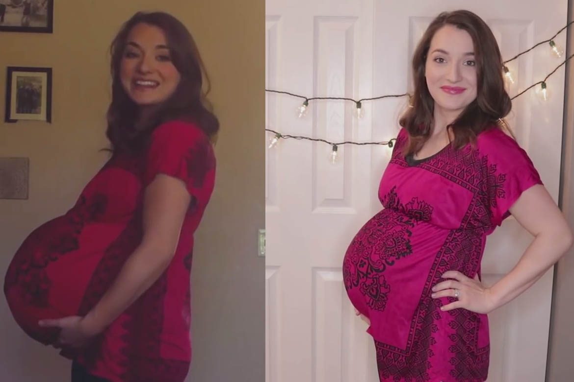 this women have Twin Pregnancy Belly