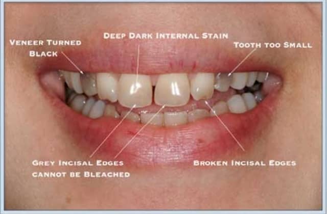 Stress Lines in Teeth
