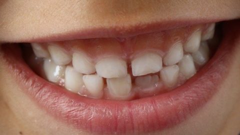 Stress Lines in Teeth