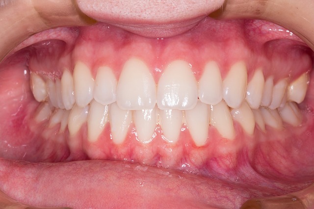 Unhealthy Gums