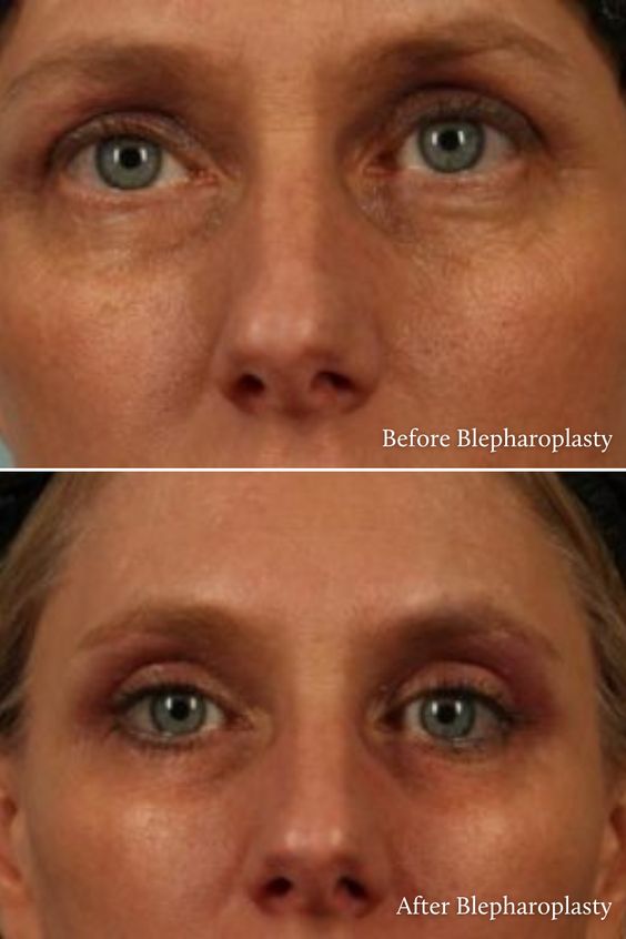 blepharoplasty surgery